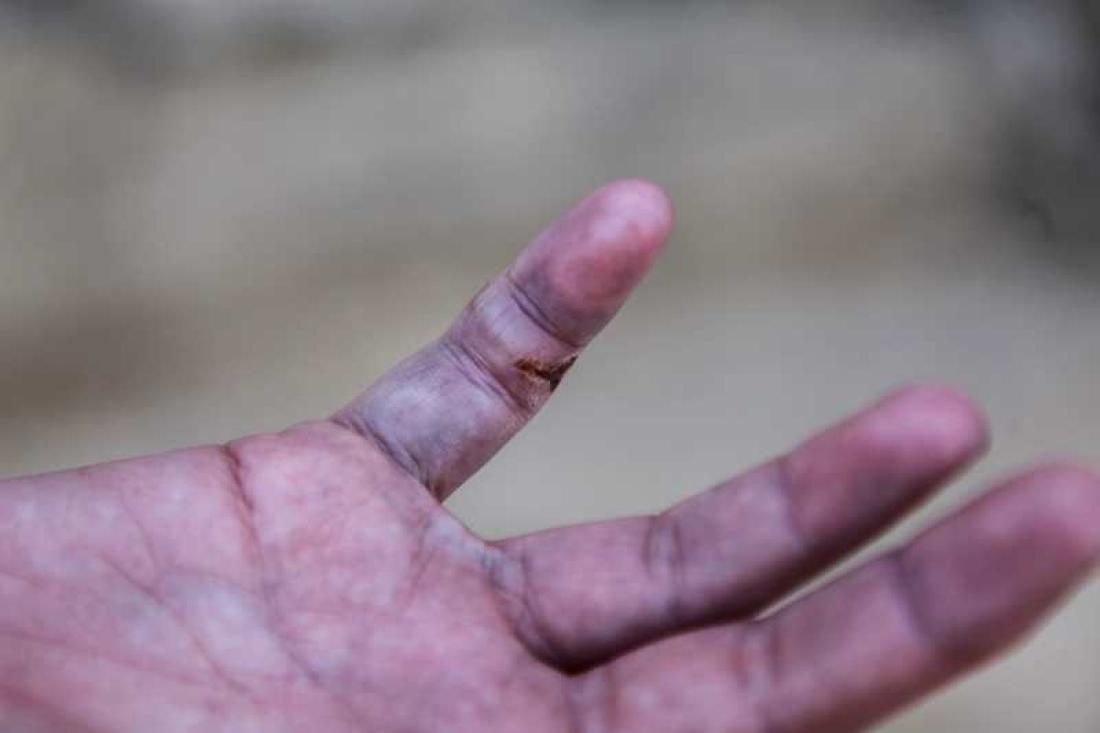 Renate ble bitt i fingeren