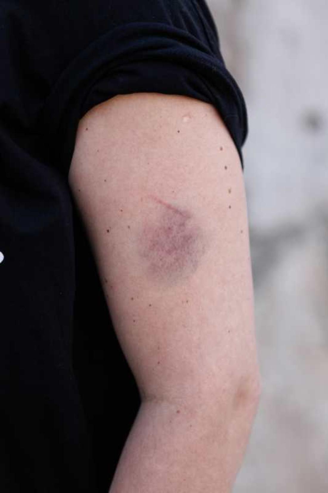 Blåmerke på Anettes arm