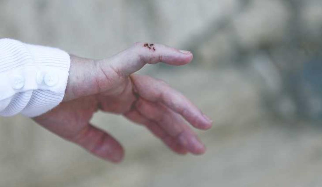 Renate ble bitt i fingeren